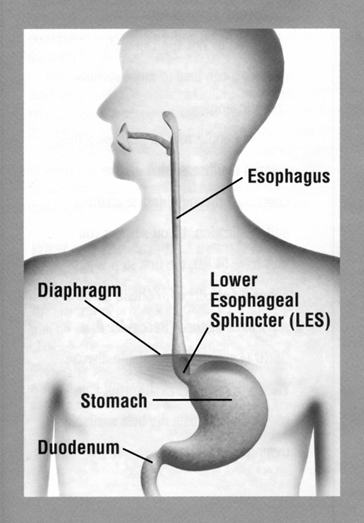 Symptoms of GERD Symptoms of GERD